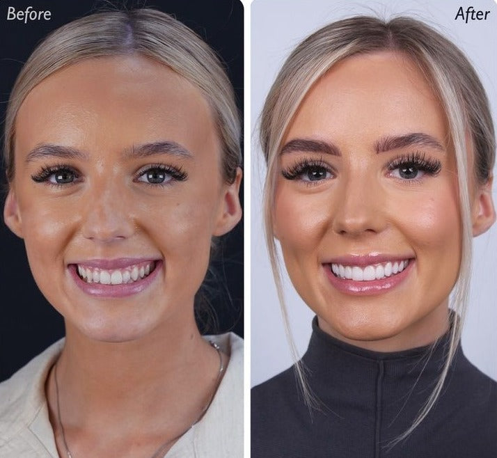 Instant Smile Cosmetic Teeth Set - Top & Bottom Veneer Look