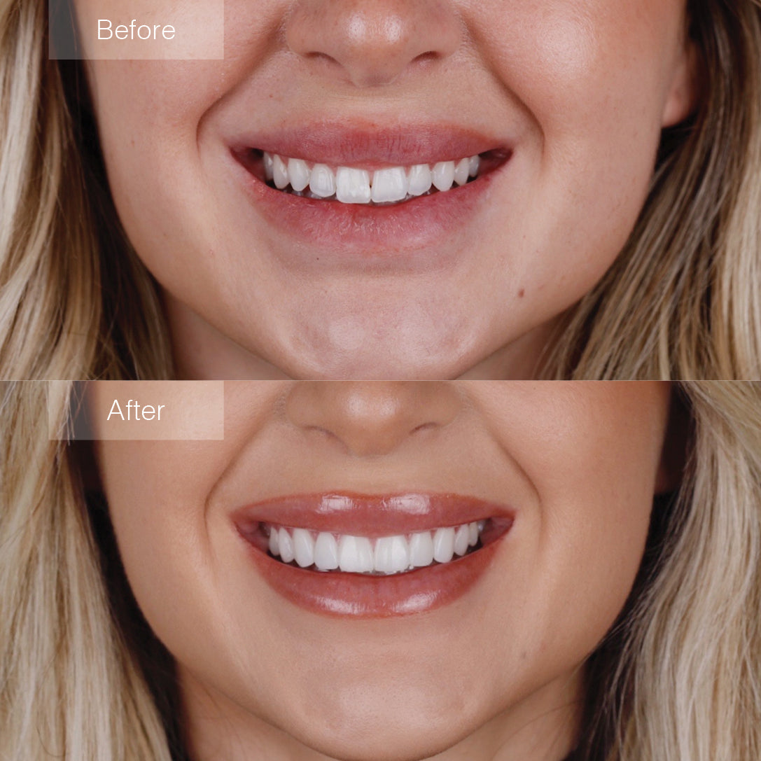 Instant Smile Cosmetic Teeth Set - Top & Bottom Veneer Look