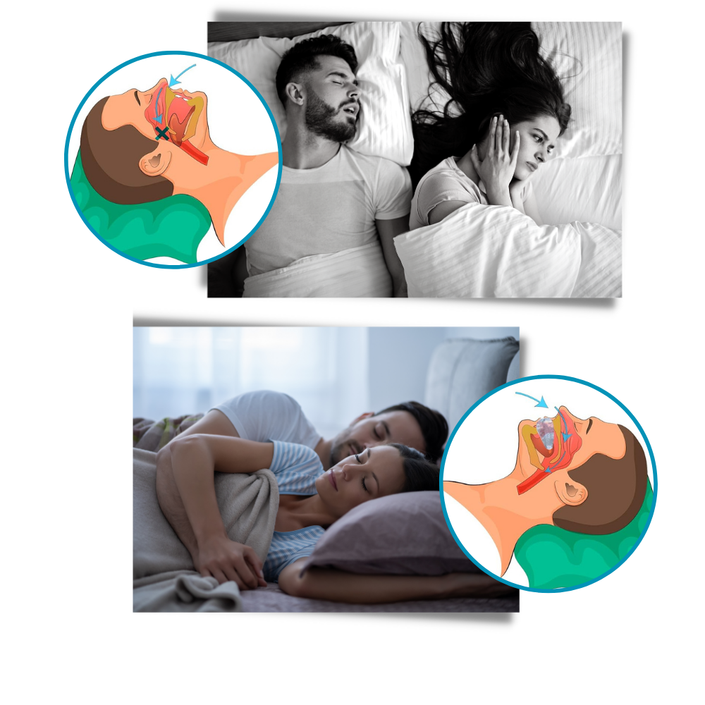 Advanced Anti-Snoring Mouthpiece Device