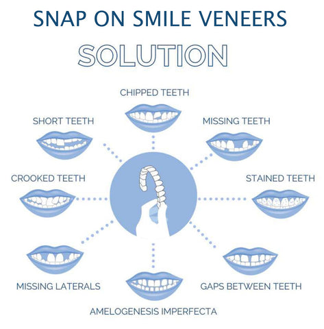 Clip-On Smile Veneers - Upper & Lower Set