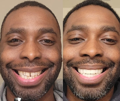 SmileFix Dental Prosthesis - Cosmetic Tooth Overlay