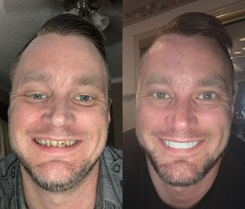 SmileFix Dental Prosthesis - Cosmetic Tooth Overlay