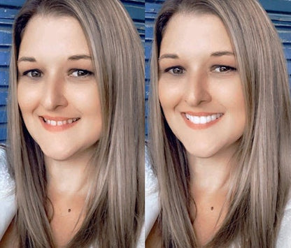 SmileFix Dental Prosthesis - Cosmetic Tooth Overlay